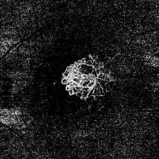 脈絡膜新生血管のOCTアンギオ画像