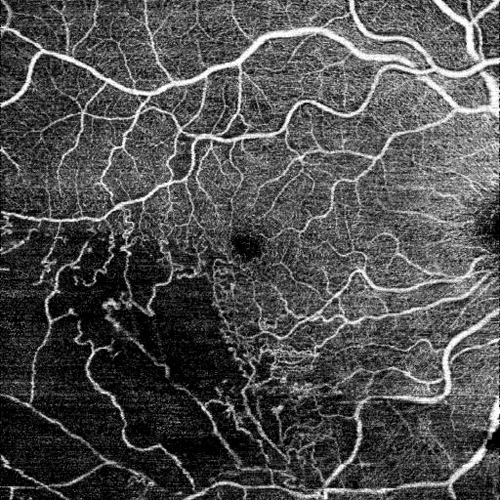 網膜静脈分枝閉塞症のOCTアンギオの画像  